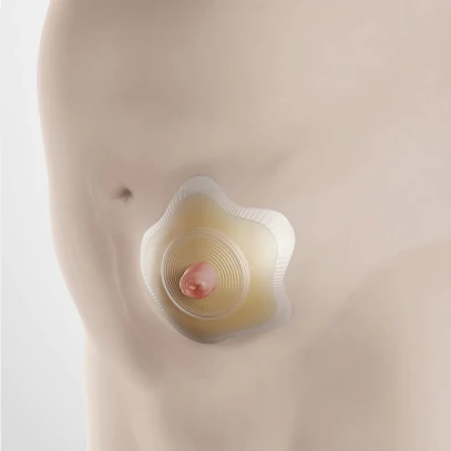 Coloplast SenSura Mio Click Konkav Basisplatte, RR 70mm, Stoma 50mm, P=5 Stück, PZN 12547815 6 Coloplast SenSura Mio Click Konkav Basisplatte, RR 70mm, Stoma 50mm, P=5 Stück, PZN 12547815 – Bild 4