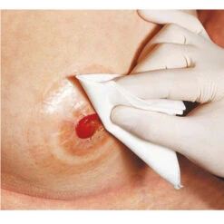 Aktionspaket = Coloplast Derma Sol Plus, 230ml Pflasterentferner + Vliwasoft Stomakompressen, 10x10cm, 4-fach, Saugstarke Kompresse Zur Stomapflege -Coloplast Verkaufsgeschäft Stomareinigung 2 1 1